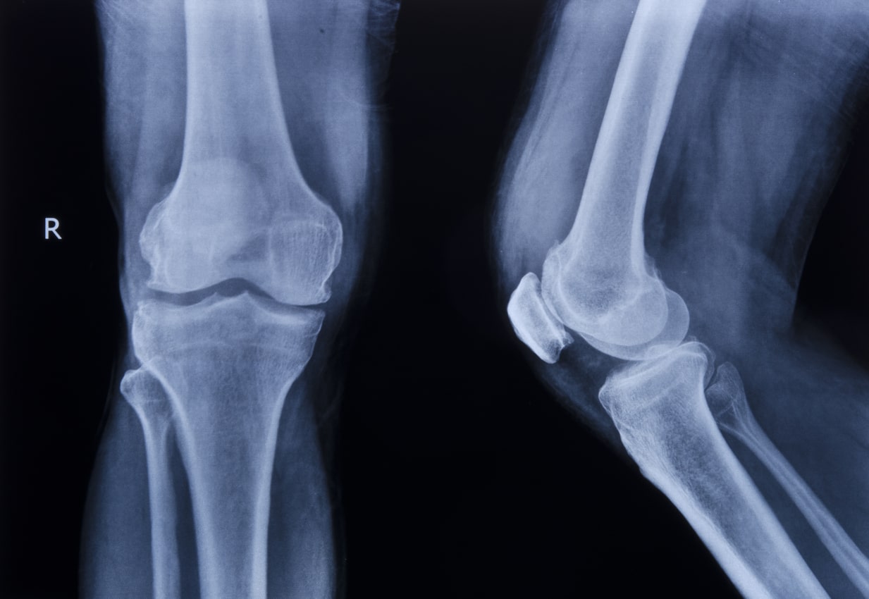 Front and side view of knee from xray